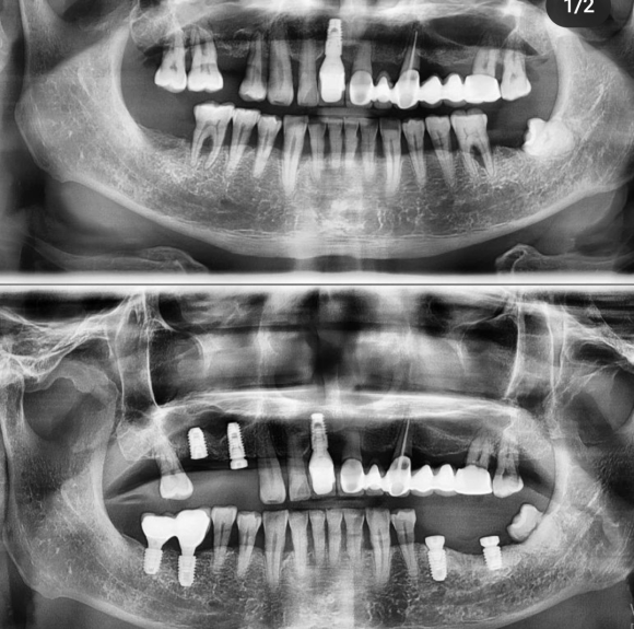 [숭실대입구역] [임플란트] 리더스진치과 2022.3.30 발치후 즉시 임플란트/상악동/뼈이식GBR AND 릿지스플릿 관련 이미지 1