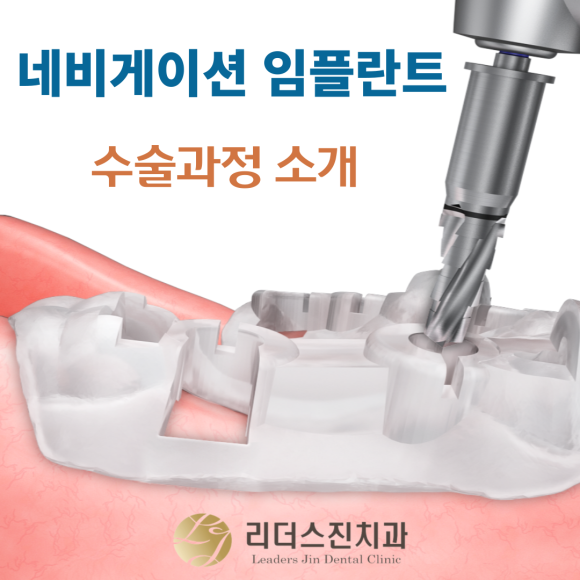 <상도동치과> 네비게이션 임플란트 수술과정 소개, 리더스진치과 관련 이미지 1