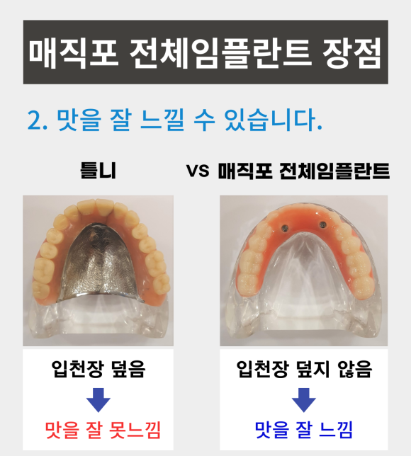무치악환자들이 추천하는 매직포 전체임플란트 장점, <전체임플란트 중점치과 리더스진치과> 관련 이미지 3