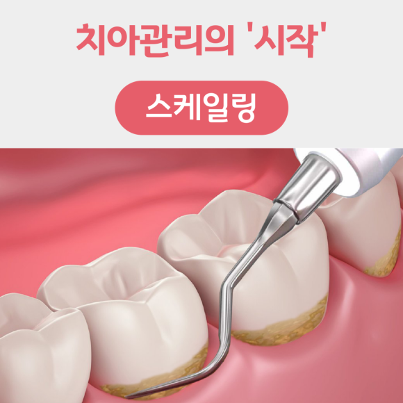 뇌졸증 치매 심혈관질환 당뇨를 예방하는 스케일링! 관련 이미지 3