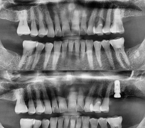 [숭실대입구역] 리더스진치과 임플란트 케이스 2022.2.5 관련 이미지 1