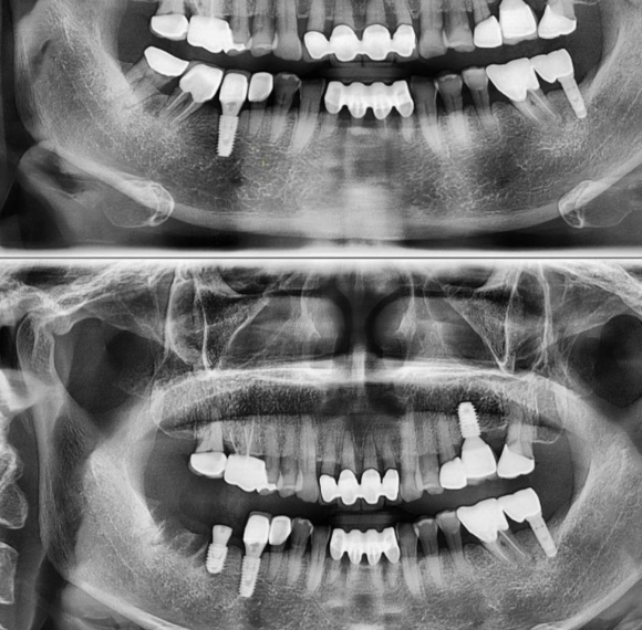 [숭실대입구역] [임플란트] 제휴 대기업 회사 임원님의 임플란트 식립. 관련 이미지 1