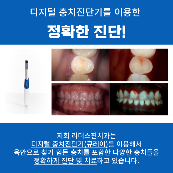 상도동 치과, 충치진행 단계별 치료방법은?? 관련 이미지 7