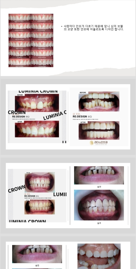 <<<<리더스진치과의 심미보철(루미니어크라운) 프로토콜>> 관련 이미지 3