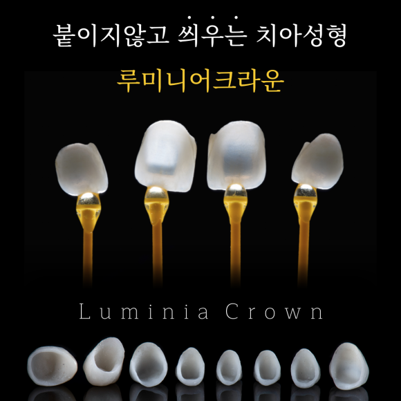 나이 상관없이 환하게 웃고싶다면? 붙이지 않고 씌우는 치아성형 관련 이미지 1