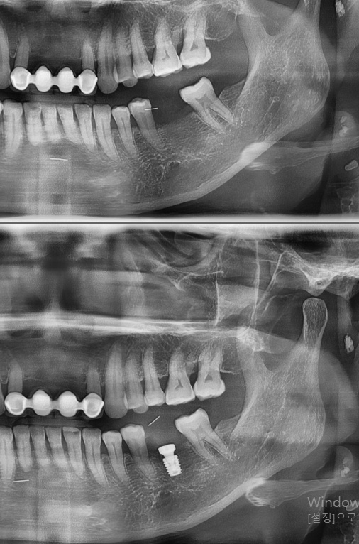 [숭실대입구역] [임플란트] 리더스진치과 2022.5.26 발치후 즉시 임플란트 상악동수술 뼈이식 관련 이미지 1