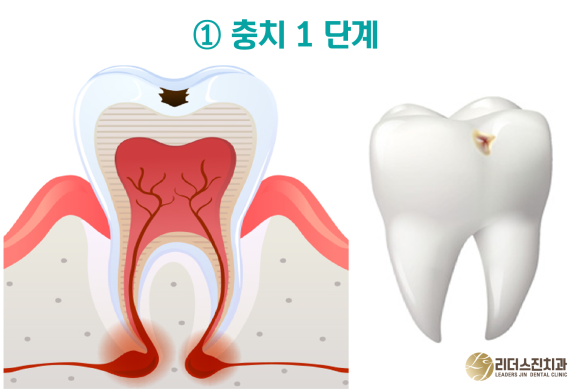 상도동 치과, 충치진행 단계별 치료방법은?? 관련 이미지 2