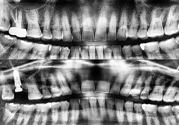 [숭실대입구역] [임플란트] 리더스진치과 2022.7.13 덴샤버를 이용한 무른 뼈의 발치 후 즉시 임플란트 식립과 상악동 거상술 관련 이미지 1