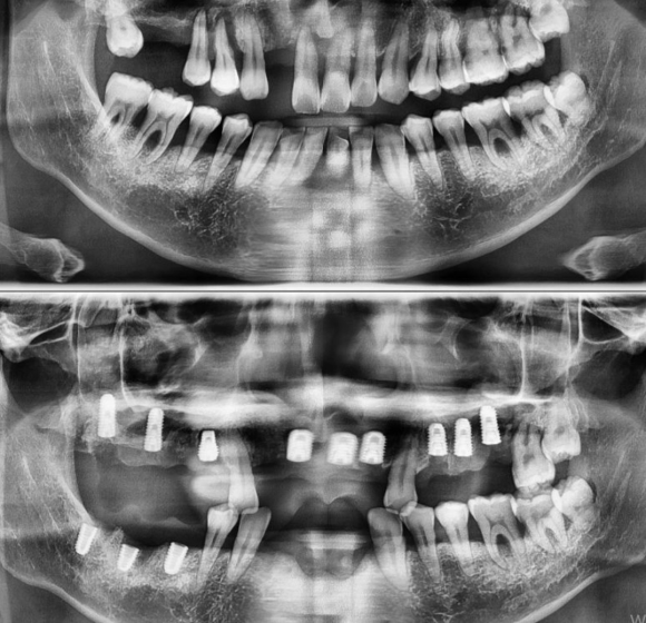 [숭실대입구역] [임플란트] 리더스진치과 2022.7.8 폭탄맞은 잇몸을 가진 환자의 전체 임플란트 진행 ING 관련 이미지 1