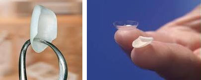 [숭실대입구역] [심미보철] 루미네이트 루미니어크라운 앞니 심미보철 완성. 관련 이미지 3