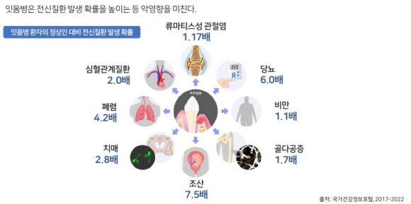 뇌졸증 치매 심혈관질환 당뇨를 예방하는 스케일링! 관련 이미지 2