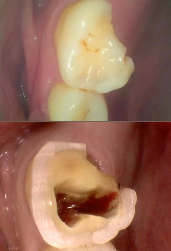 [숭실대입구역] 리더스진치과 임플란트 케이스 2022.2.5 관련 이미지 2