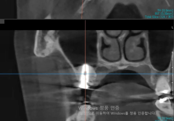 [숭실대입구역] [임플란트] 리더스진치과 2022.7.13 덴샤버를 이용한 무른 뼈의 발치 후 즉시 임플란트 식립과 상악동 거상술 관련 이미지 2