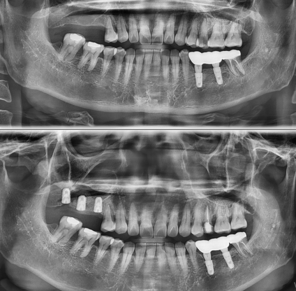 [숭실대입구역] [임플란트] 리더스진치과 2022.5.19 Ridge split, 상악동수술, 뼈이식 그리고 치조골 확장술을 동반한 임플란트 식립 관련 이미지 1