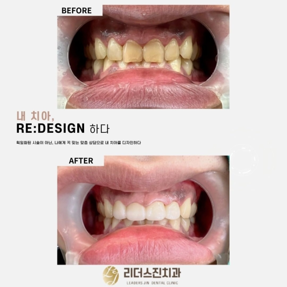 [숭실대입구역] [심미보철] 미스터트로트2 출연 예정 방송인 앞니 심미보철 완성. 관련 이미지 1