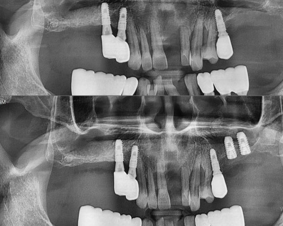 [숭실대입구역] 리더스진치과 임플란트 케이스 2022.2.3 관련 이미지 1