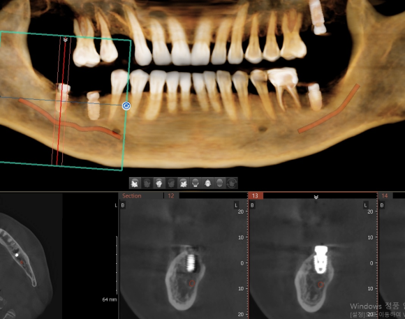 [숭실대입구역] [임플란트] 리더스진치과 2022.6.30 인천에서 오신 분의 당일 내과 협진 후 임플란트 식립 관련 이미지 5