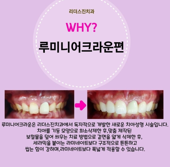 [숭실대입구역] [심미보철] 리더스진치과 심미보철 연예인보철 인플루언서치과 앞니성형 루미니어크라운 관련 이미지 1