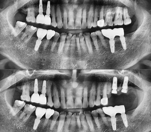 [숭실대입구역] [임플란트] 리더스진치과 2022.4.2 발치후 즉시 임플란트 상악동수술/뼈이식 + 즉시 로딩 관련 이미지 1