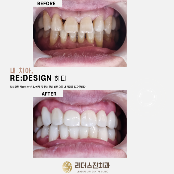 [숭실대입구역] [심미보철] 루미네이트 루미니어크라운 앞니 심미보철 완성. 관련 이미지 1