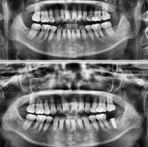 [숭실대입구역] [임플란트] 리더스진치과 2022.6.7 발치후 5개월 후 임플란트 간단 식립 케이스 관련 이미지 1