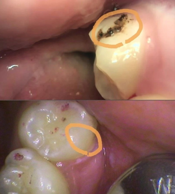 [숭실대입구역] [충치치료] 리더스진치과 2022.3.6 충치치료 관련 이미지 1