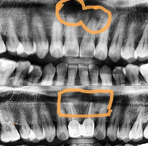 [숭실대입구역] [신경치료] 신경치료 후 1년 F/U 사진 입니다. 관련 이미지 1