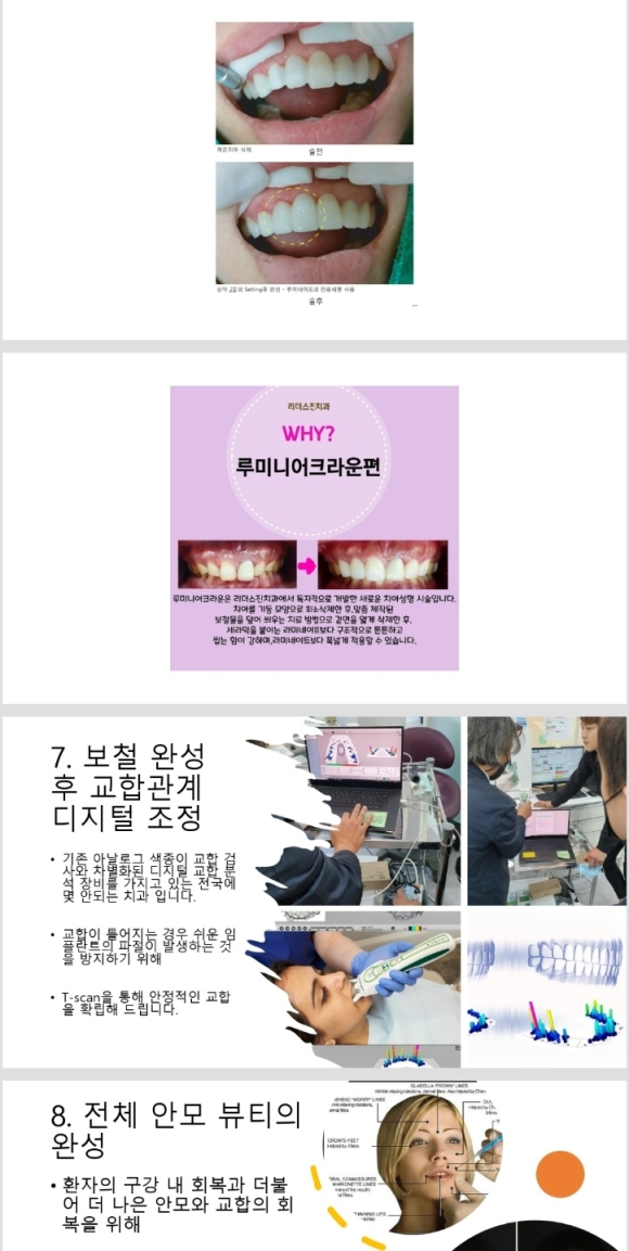 <<<<리더스진치과의 심미보철(루미니어크라운) 프로토콜>> 관련 이미지 8