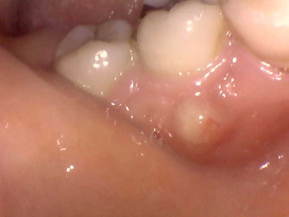 무증상의 치근단 농양, 잠재적인 생명 위협 관련 이미지 6