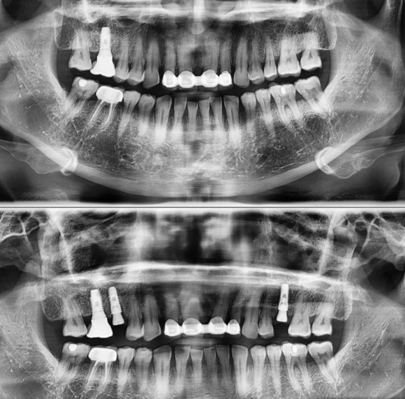 [숭실대입구역] [임플란트] 발치 후 즉시 임플란트 식립술 관련 이미지 1