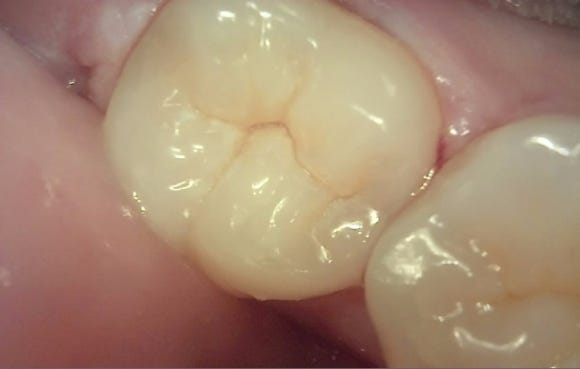 [숭실대입구역] 리더스진치과 - 충치진단기를 이용한 충치 검진과 간단한 충치치료 그리고 충치치료비용/ 치과마다 충치갯수가 다른 것을 해결하는 방법. 관련 이미지 1