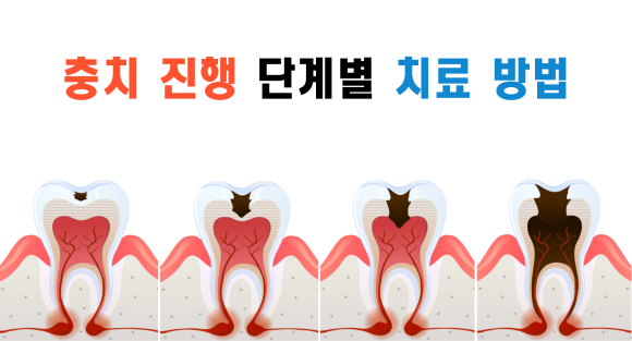 상도동 치과, 충치진행 단계별 치료방법은?? 관련 이미지 1