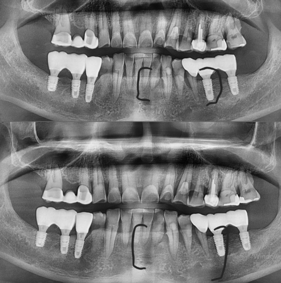 [리더스진 치과] 잇몸질환 으로 무너져버린 뼈 그리고 당일식립 임플란트 치료 전략 관련 이미지 1