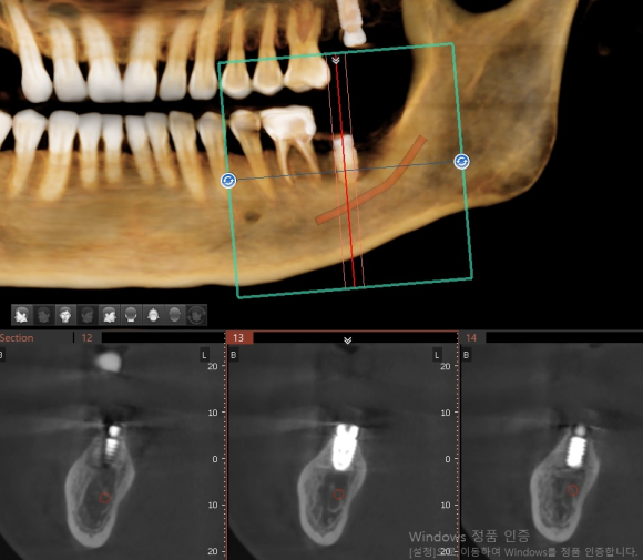 [숭실대입구역] [임플란트] 리더스진치과 2022.6.30 인천에서 오신 분의 당일 내과 협진 후 임플란트 식립 관련 이미지 3
