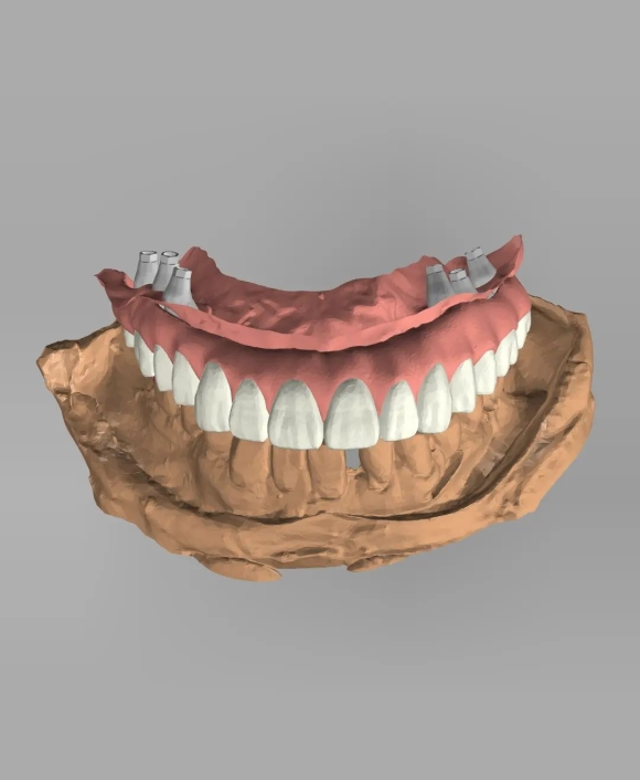 [숭실대입구역] [임플란트] 리더스진치과의 임플란트 수술 시 스캐너와 3D 분석을 이용한 정확한 임플란트 보철 (매직4,매직6) 관련 이미지 1