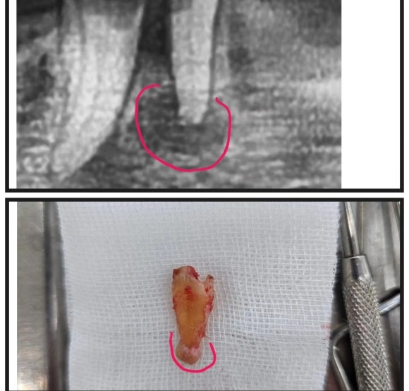 무증상의 치근단 농양, 잠재적인 생명 위협 관련 이미지 3