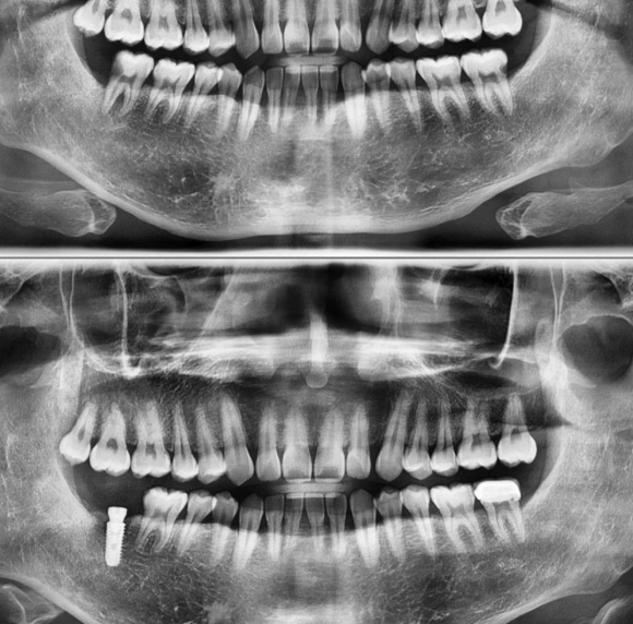 [숭실대입구역] [임플란트] 원장 지인 친구의 임플란트 식립. 관련 이미지 1