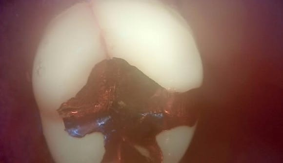 [숭실대입구역] 리더스진치과 Cracked 치아 발치 후, 뼈이식 케이스 2022.2.7 관련 이미지 3