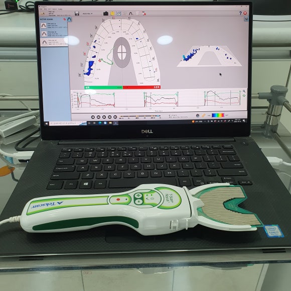 치아 교합을 정확하게 분석하는 [디지털 교합분석장비], "T-scan(티스캔)" 상도동치과, 리더스진치과 관련 이미지 2
