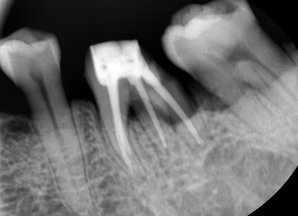 [숭실대입구역][리더스진치과] 신경치료 과정과 마무리 후 보철 프랩 케이스 관련 이미지 1