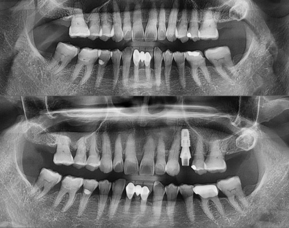 [숭실대입구역] 리더스진치과 임플란트 케이스 2022.1.29 관련 이미지 1