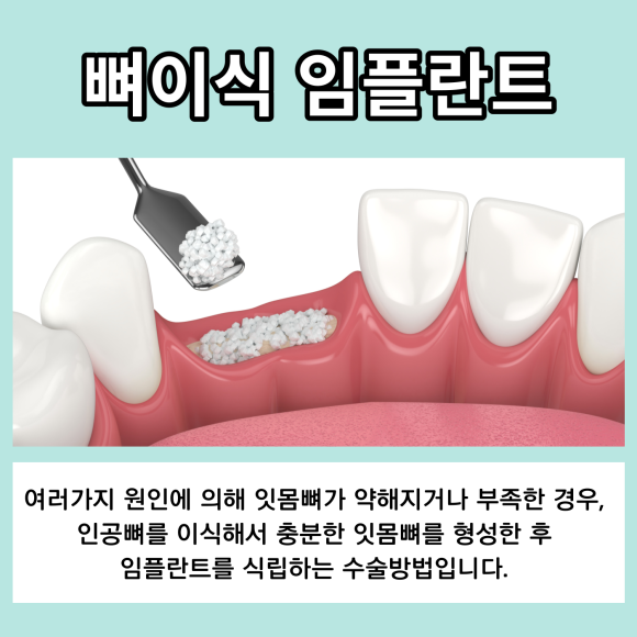 잇몸뼈가 부족할땐? 관련 이미지 2