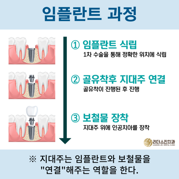 맞춤형 지대주를 이용한 1:1 맞춤 임플란트 <전체임플란트 중점치과 리더스진치과> 관련 이미지 2