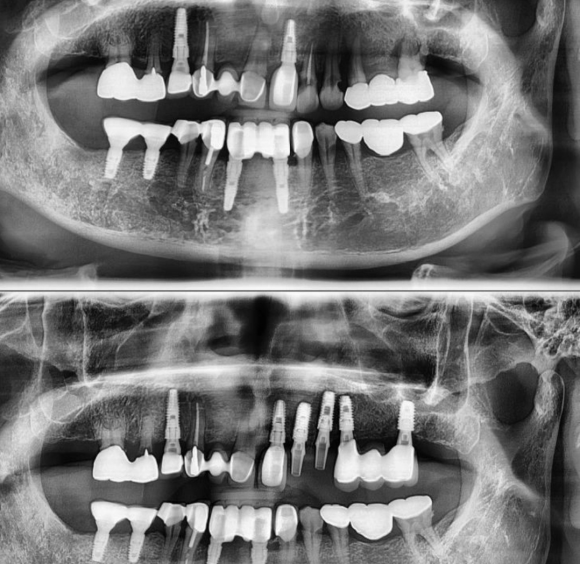 [숭실대입구역] [임플란트] 리더스진치과 2022.3.28 발치후 즉시 임플란트 + 즉시 로딩 관련 이미지 1