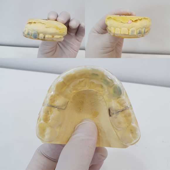 잠잘 때 이갈이 하시나요? 이갈이 마우스피스의 중요성 관련 이미지 5