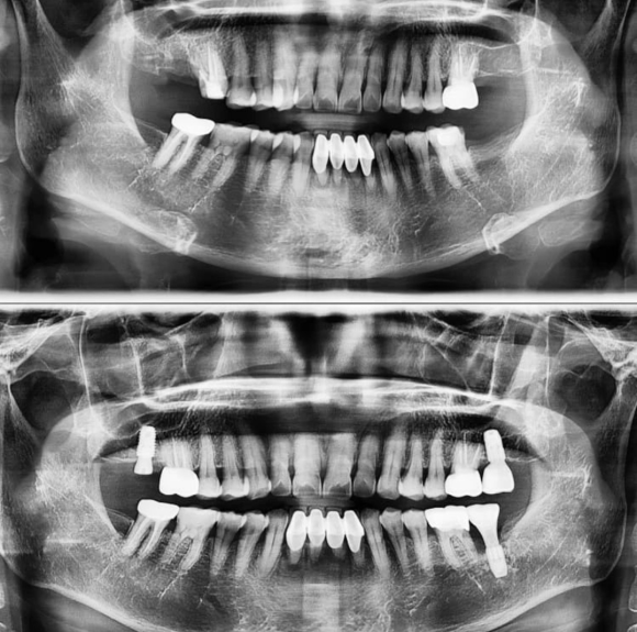 [숭실대입구역] [임플란트] 리더스진치과 2022.6.15 발치 후 당일 즉시 식립 임플란트 수술. 관련 이미지 1