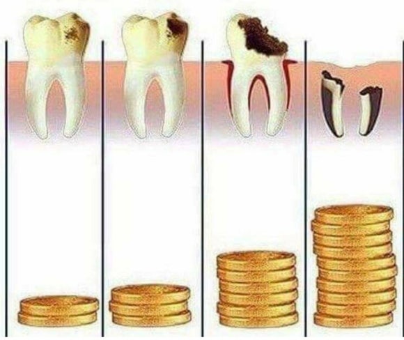 [리더스진치과] 충치진단기를 이용한 충치진단 그리고 충치치료, 언제 신경치료를 해야하는지, 방사선 사진과 임상사진으로 확인 후 진단과정 공개 관련 이미지 2