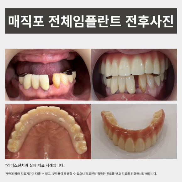 무치악환자들이 추천하는 매직포 전체임플란트 장점, <전체임플란트 중점치과 리더스진치과> 관련 이미지 6