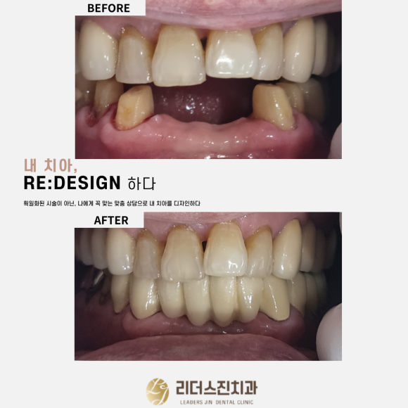 [숭실대입구역] [심미보철] 루미네이트 루미니어크라운 앞니 심미보철 완성.(70대남환) 관련 이미지 1