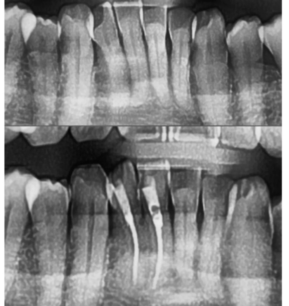 [숭실대입구역] [신경치료] 리더스진치과 2022.4.13 하악 시린니 신경치료 당일 발수 후 근관 충전 완료. 관련 이미지 1